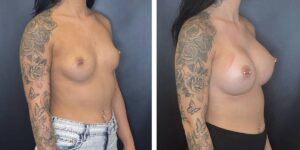 before and after breast augmentation female patient right angled view case 2070