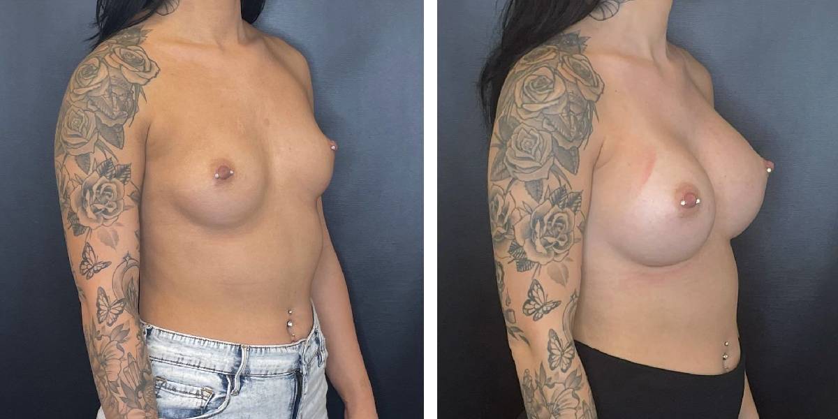 before and after breast augmentation female patient right angled view case 2070