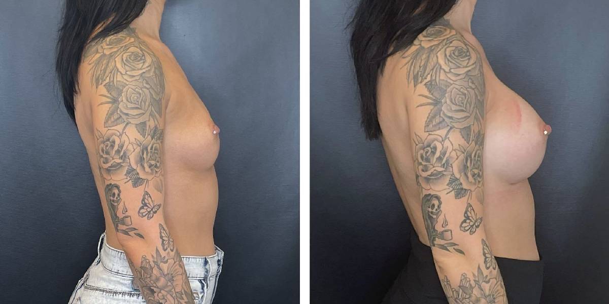 before and after breast augmentation female patient right side view case 2070