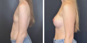 before and after breast augmentation female patient left side view case 2076
