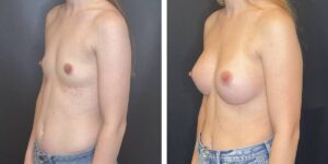 before and after breast augmentation female patient left angled view case 2076