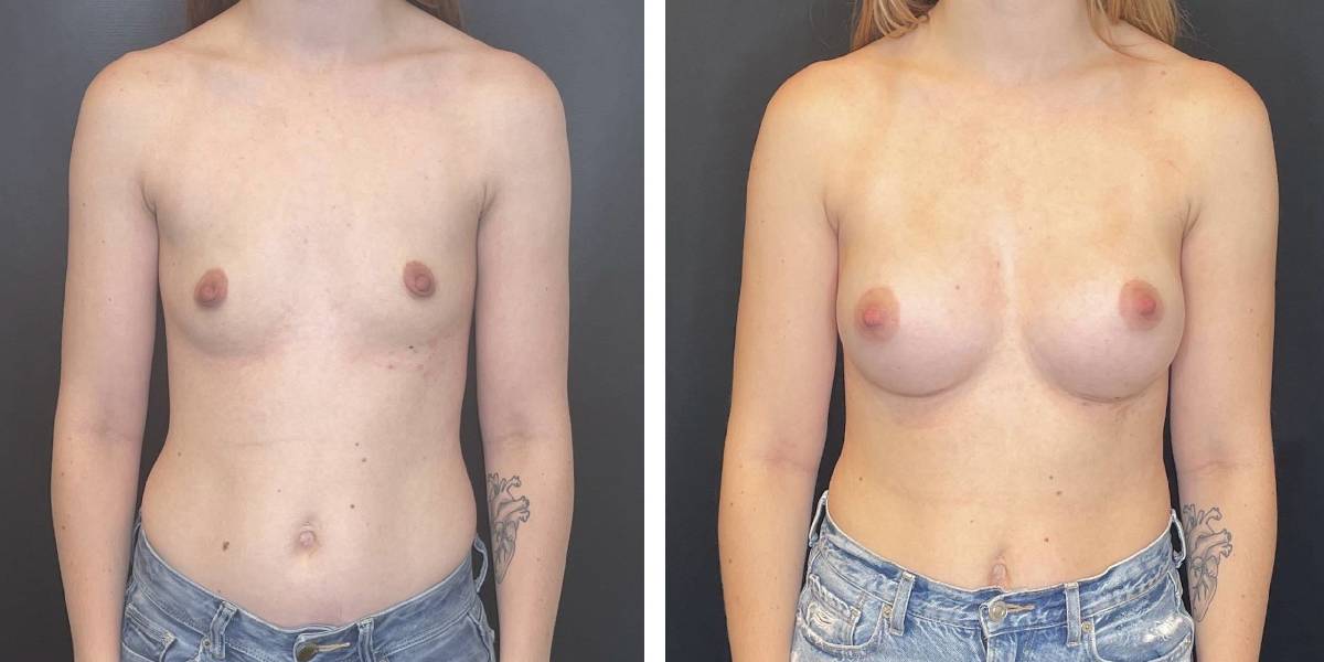 before and after breast augmentation female patient front view case 2076