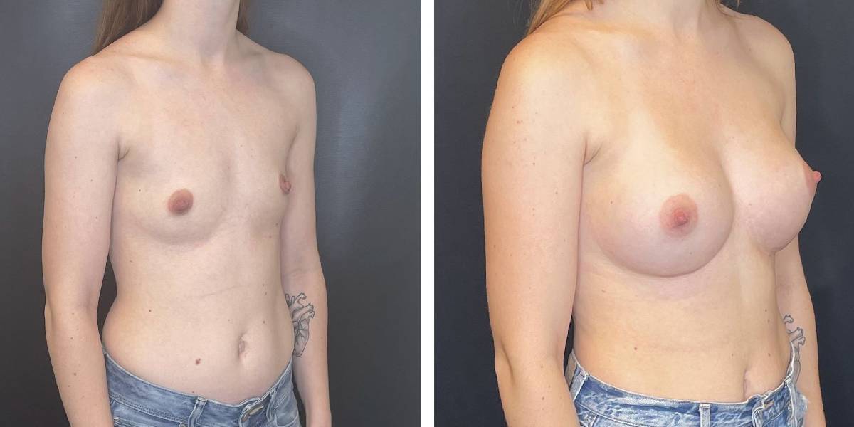 before and after breast augmentation female patient right angled view case 2076