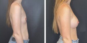 before and after breast augmentation female patient right side view case 2076