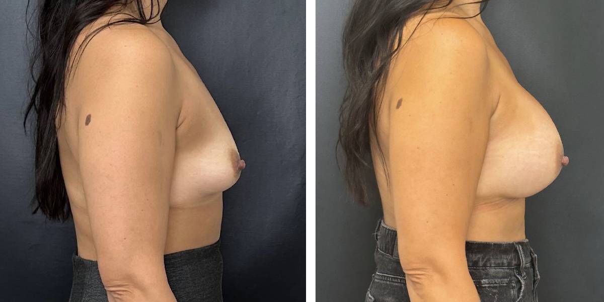 before and after breast augmentation female patient right side view case 2082