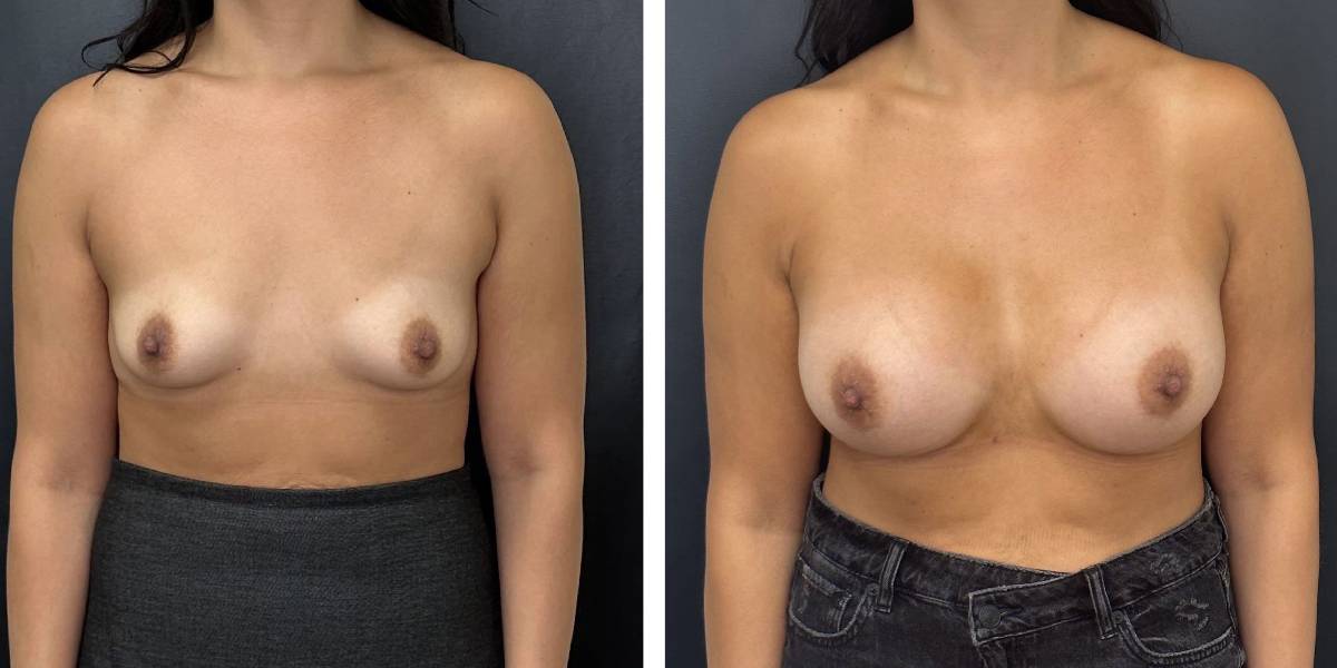 before and after breast augmentation female patient front view case 2082