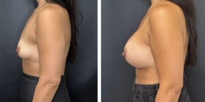 before and after breast augmentation female patient left side view case 2082