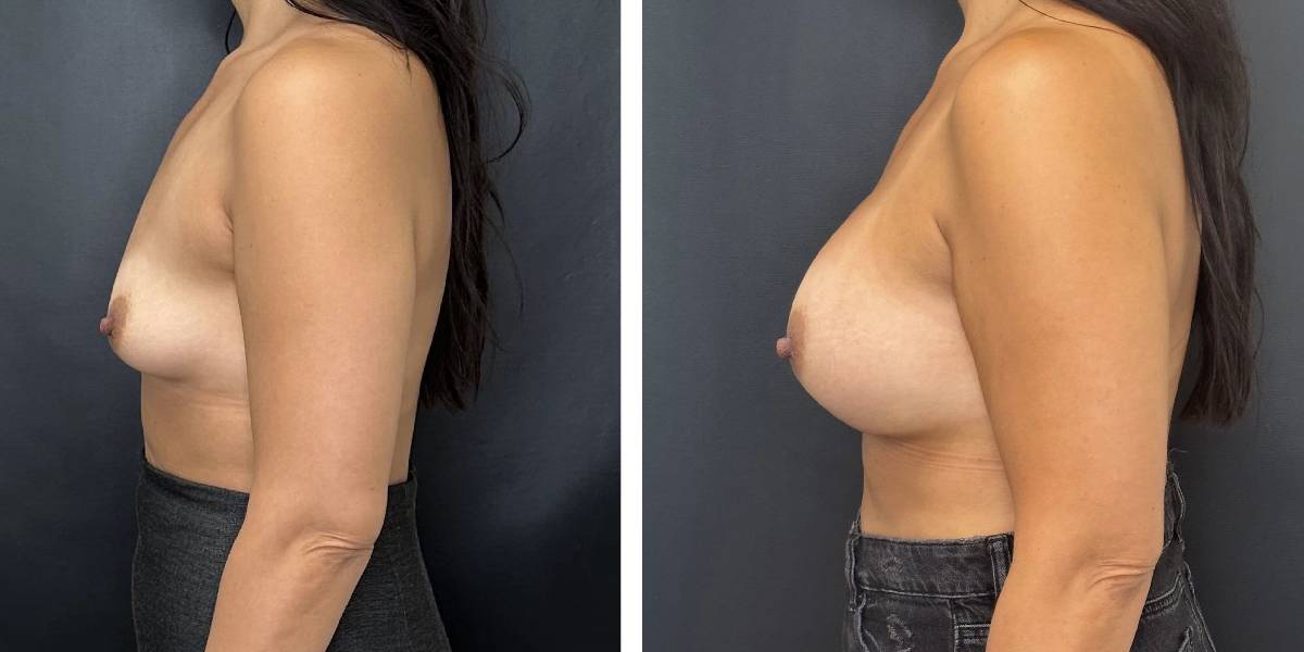 before and after breast augmentation female patient left side view case 2082