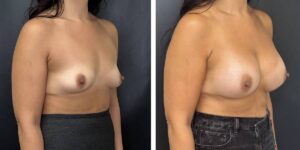 before and after breast augmentation female patient right angled view case 2082