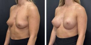 before and after breast augmentation female patient left angled view case 2091
