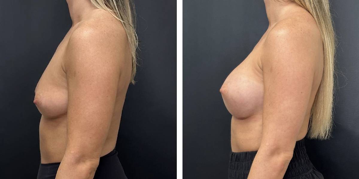 before and after breast augmentation female patient left side view case 2091