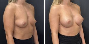 before and after breast augmentation female patient right angled view case 2091