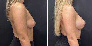 before and after breast augmentation female patient right side view case 2091