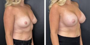 before and after breast augmentation female patient right angled view case 2104