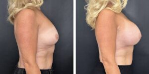 before and after breast augmentation female patient right side view case 2104