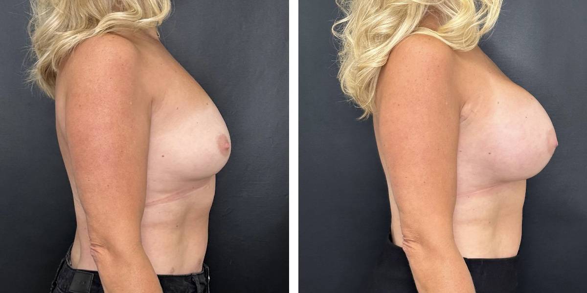 before and after breast augmentation female patient right side view case 2104