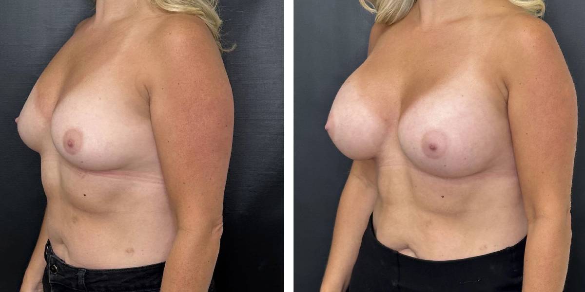 before and after breast augmentation female patient left angled view case 2104