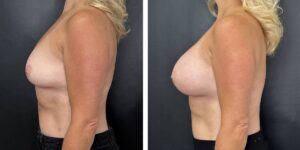 before and after breast augmentation female patient left side view case 2104