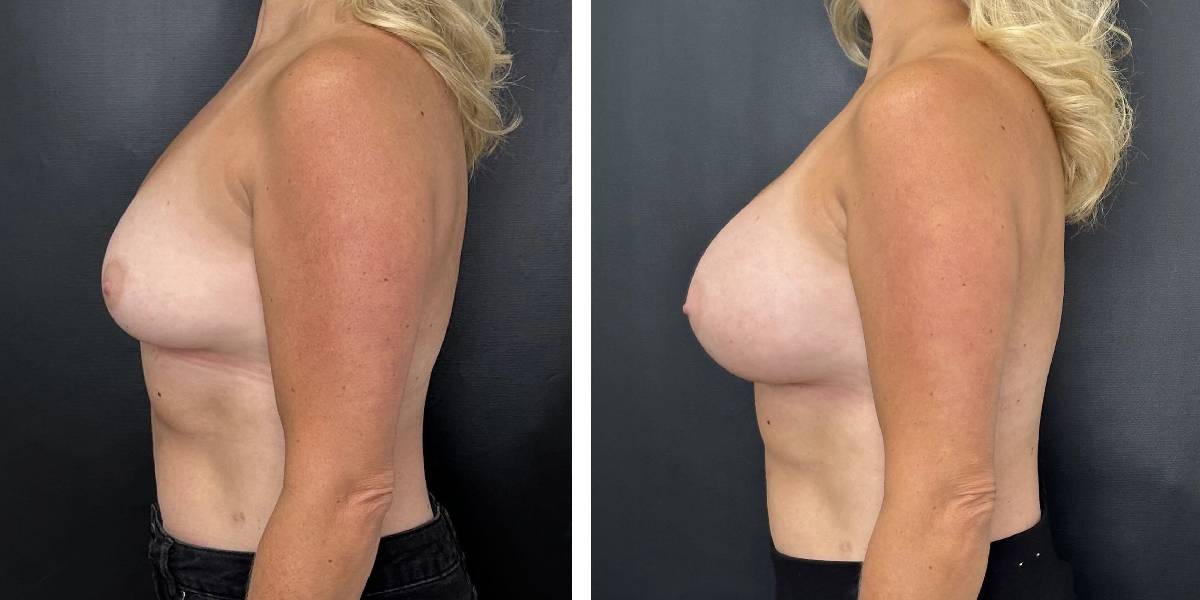 before and after breast augmentation female patient left side view case 2104