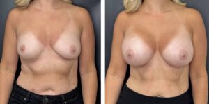 before and after breast augmentation female patient front view case 2104