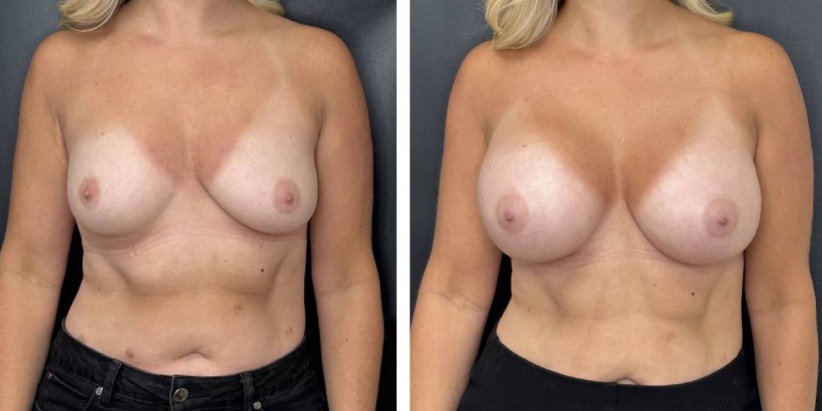 before and after breast augmentation female patient front view case 2104