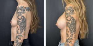 before and after breast augmentation female patient left side view case 2110