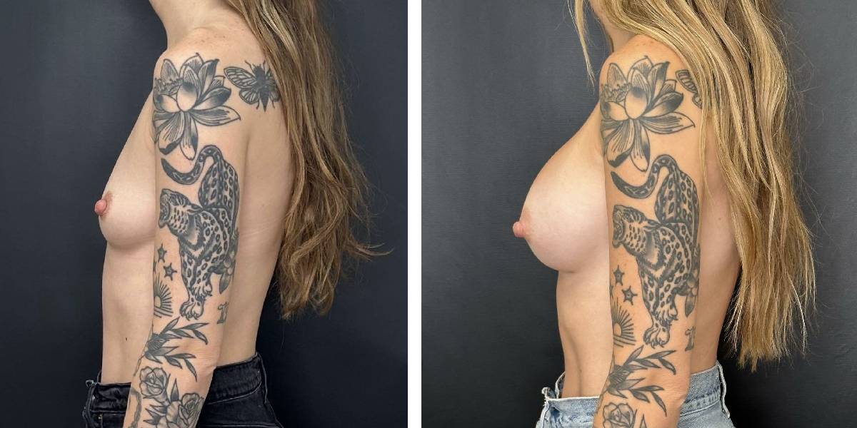 before and after breast augmentation female patient left side view case 2110