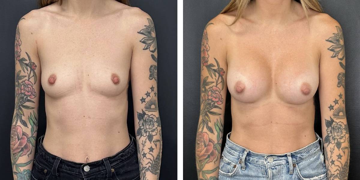 before and after breast augmentation female patient front view case 2110