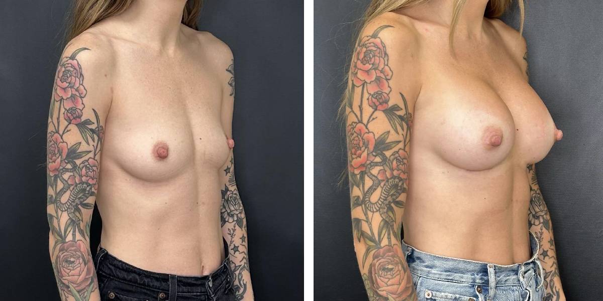before and after breast augmentation female patient right angled view case 2110
