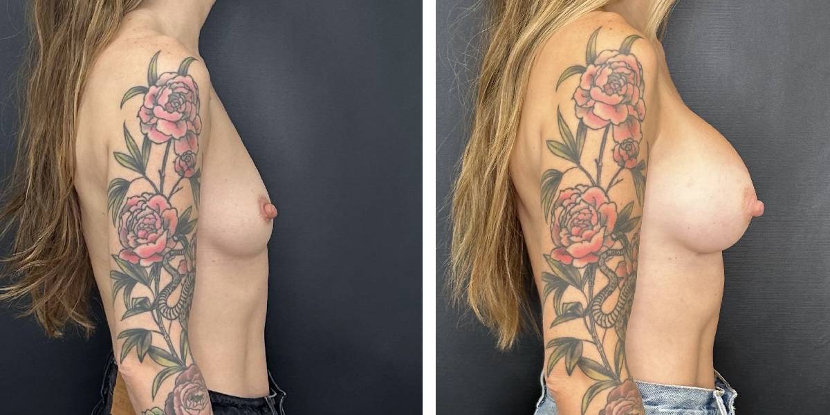 before and after breast augmentation female patient right side view case 2110