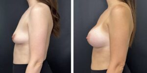 before and after breast augmentation female patient left side view case 2118