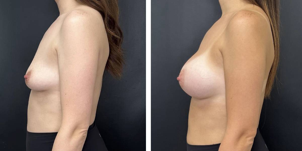 before and after breast augmentation female patient left side view case 2118