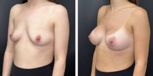 before and after breast augmentation female patient left angled view case 2118