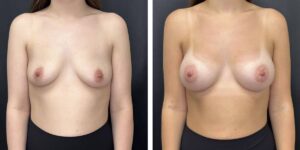 before and after breast augmentation female patient front view case 2118