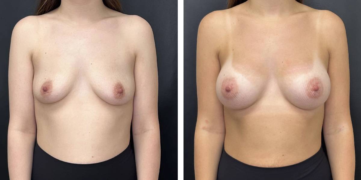 before and after breast augmentation female patient front view case 2118