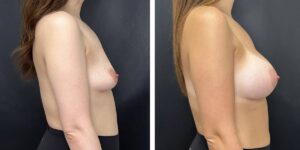 before and after breast augmentation female patient right side view case 2118