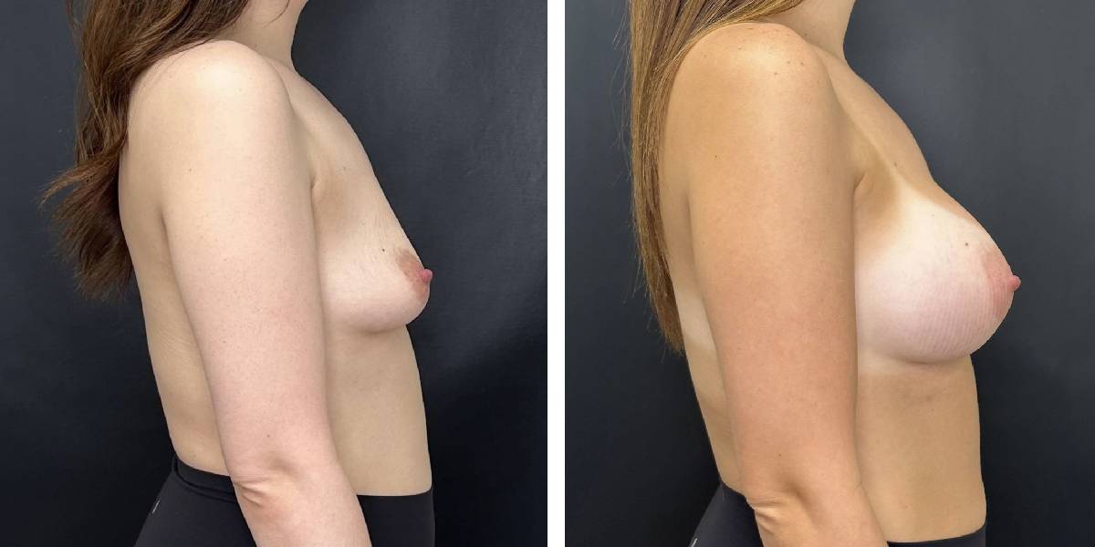 before and after breast augmentation female patient right side view case 2118