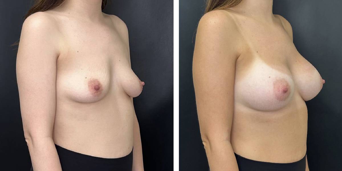 before and after breast augmentation female patient right angled view case 2118