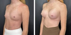 before and after breast augmentation female patient left angled view case 2124