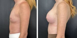 before and after breast augmentation female patient left side view case 2124