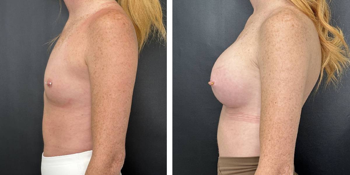 before and after breast augmentation female patient left side view case 2124
