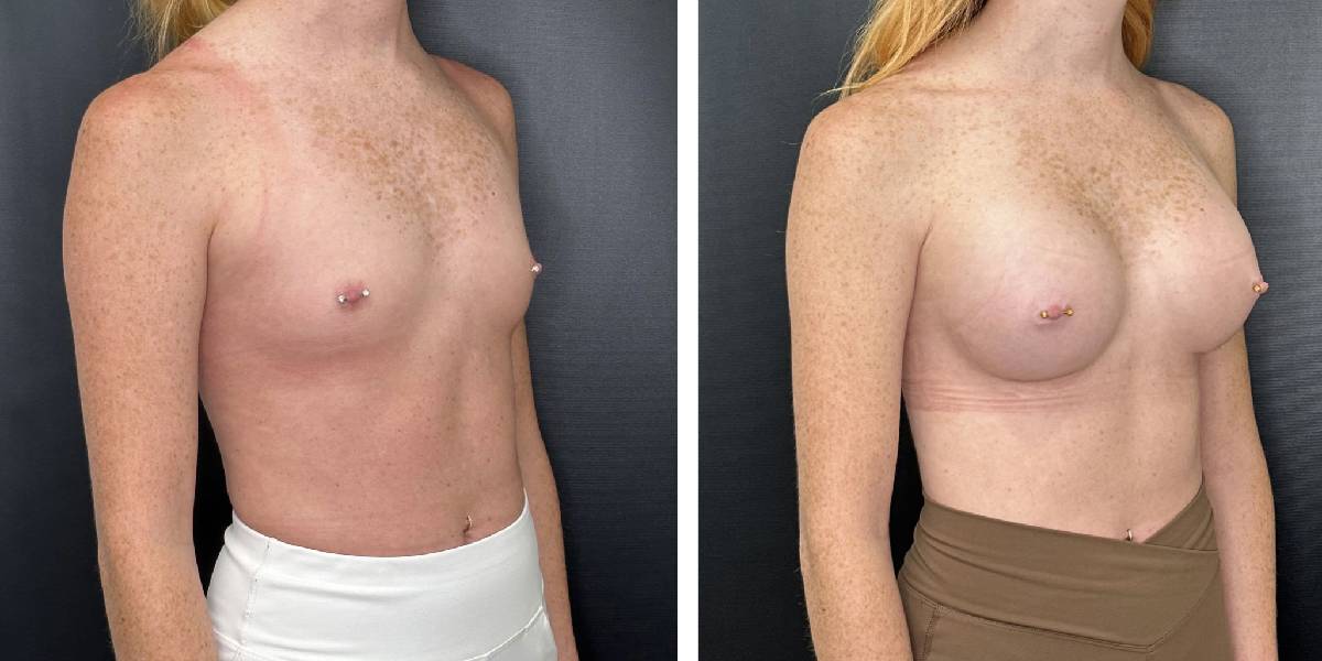 before and after breast augmentation female patient right angled view case 2124