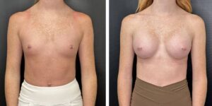 before and after breast augmentation female patient front view case 2124