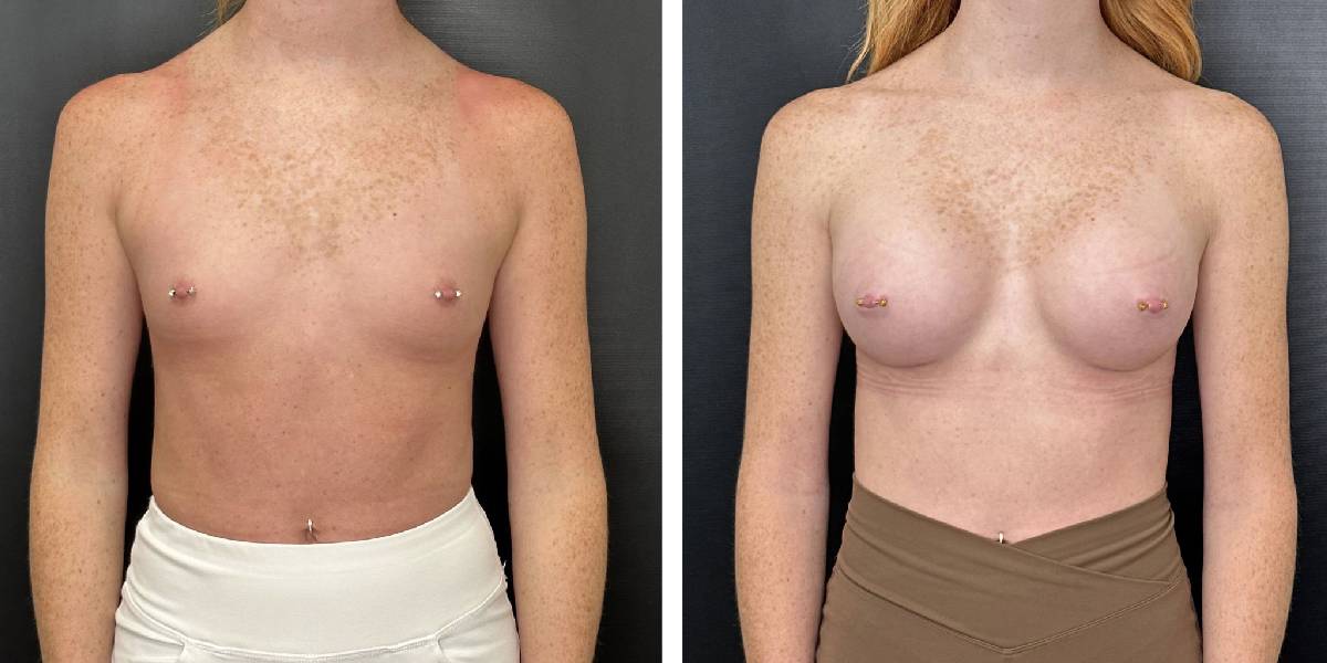 before and after breast augmentation female patient front view case 2124
