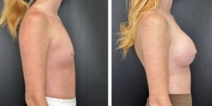 before and after breast augmentation female patient right side view case 2124