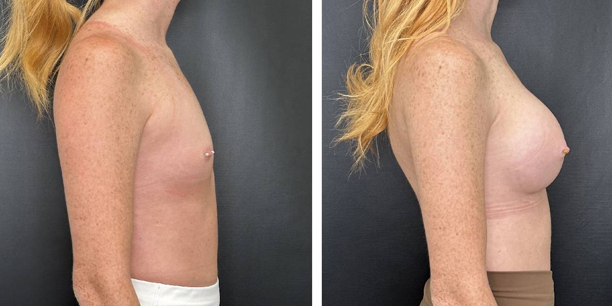 before and after breast augmentation female patient right side view case 2124