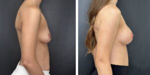 before and after breast augmentation female patient right side view case 2130