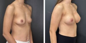 before and after breast augmentation female patient right angled view case 2130
