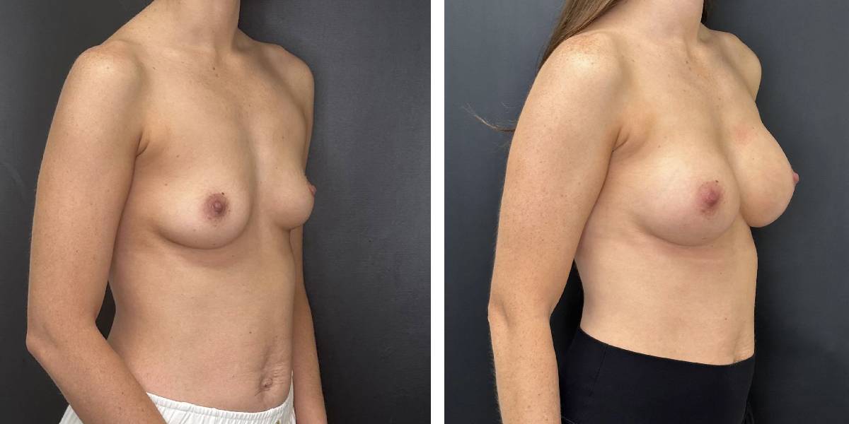 before and after breast augmentation female patient right angled view case 2130