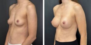 before and after breast augmentation female patient left angled view case 2130